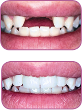 dental implants